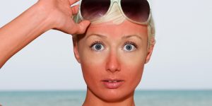 10-best-ways-to-deal-with-sunburns