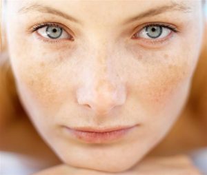 How-to-get-rid-of-brown-spots-on-the-face