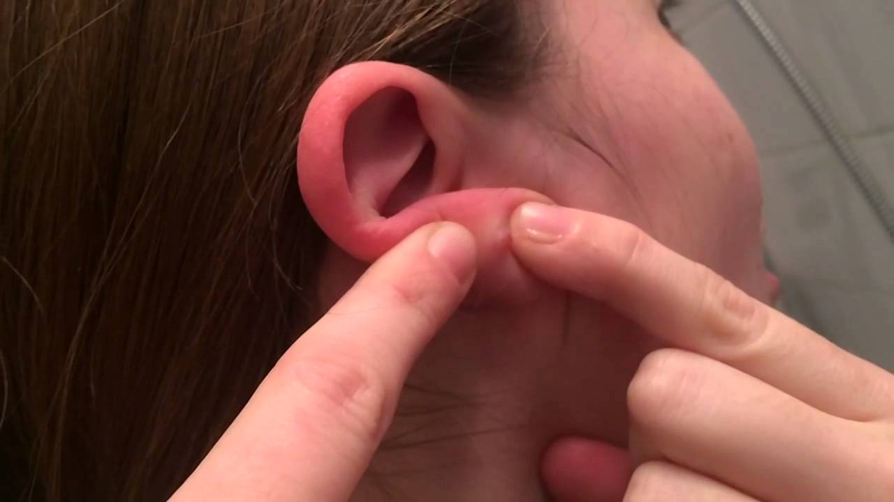 Почему упали уши у. Атерома на замочке уха.
