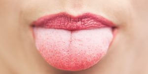 Pimples-on-the-tongue-Causes-and-Treatments