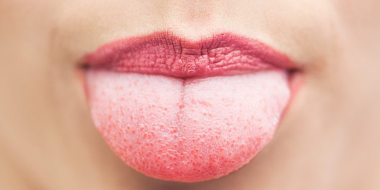 pimples-on-the-tongue-causes-and-treatments-smugg-bugg