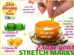 10-stretch-marks-removal-remedies