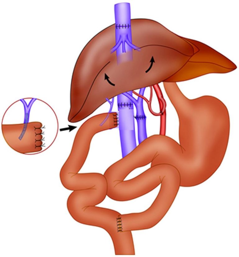 what-is-liver-transplant-and-why-do-you-need-it-smugg-bugg