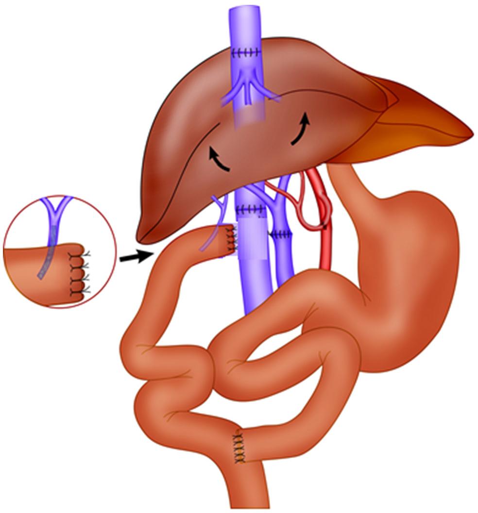 cardiac-considerations-for-the-liver-transplant-patient-consult-qd